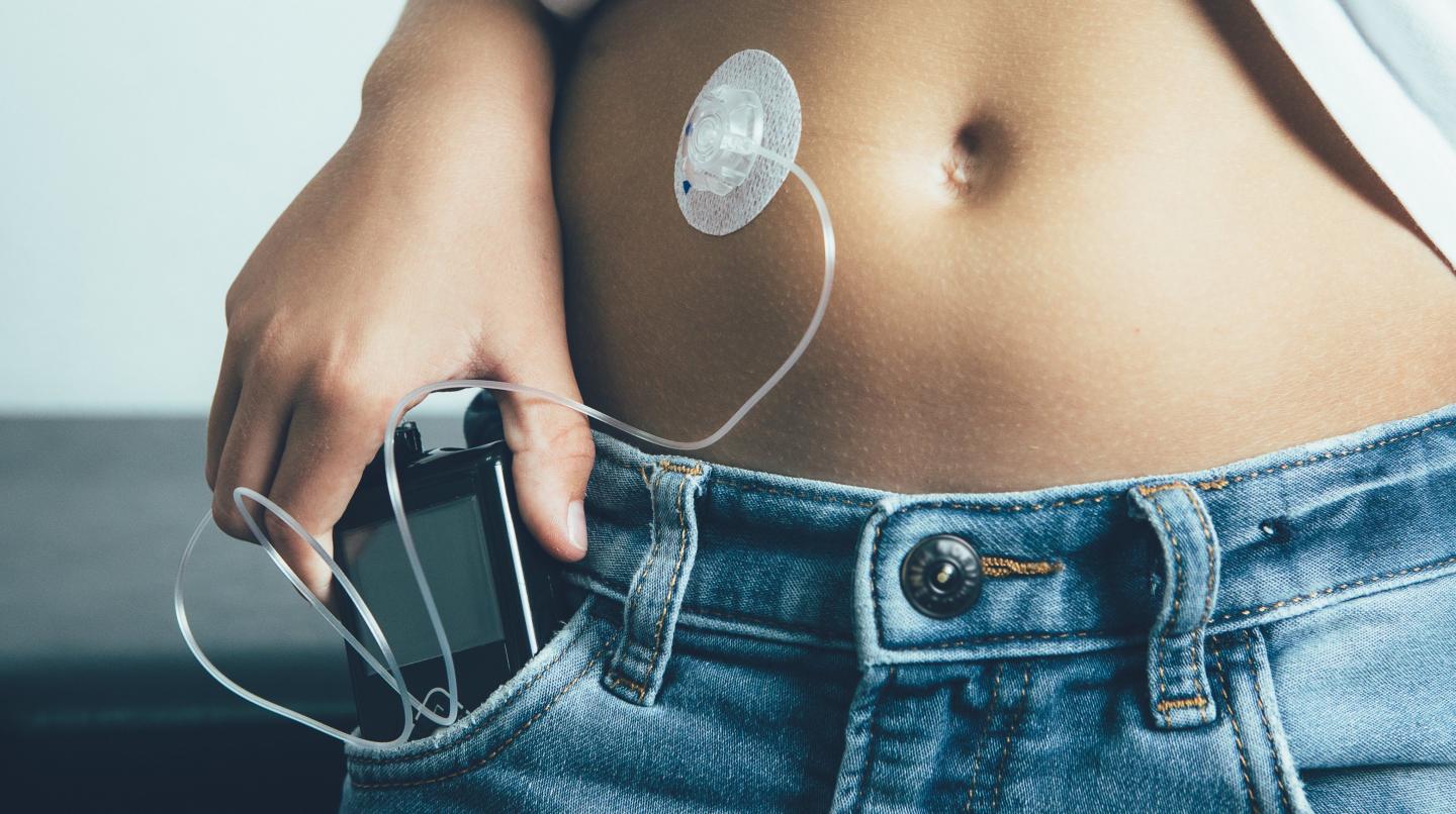 Close up view of the abdomen of a diabetic child with an insulin pump dressing connected in his abdomen and keeping the insulin pump in his pocket. Child diabetes concept.